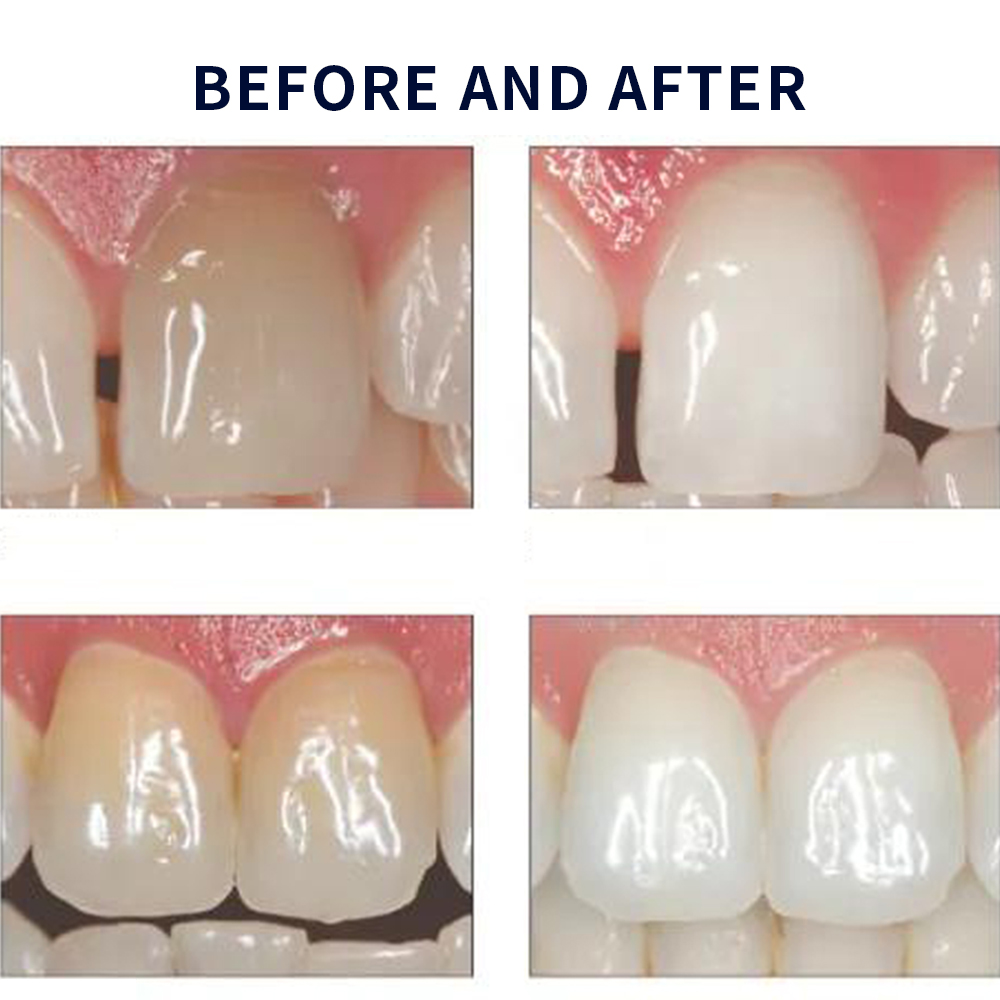 Opalescence Whitening 20% PF 2 - Teeth Whitening With Peroxide recension och pris