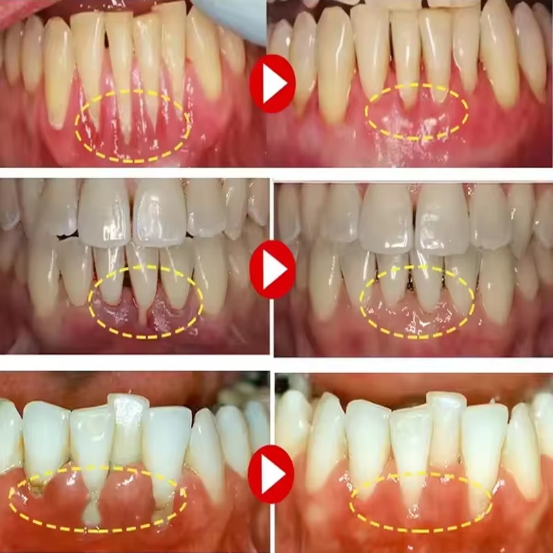 Teeth Whitening Gel Gum Repair - Teeth Whitening Gels recension och pris