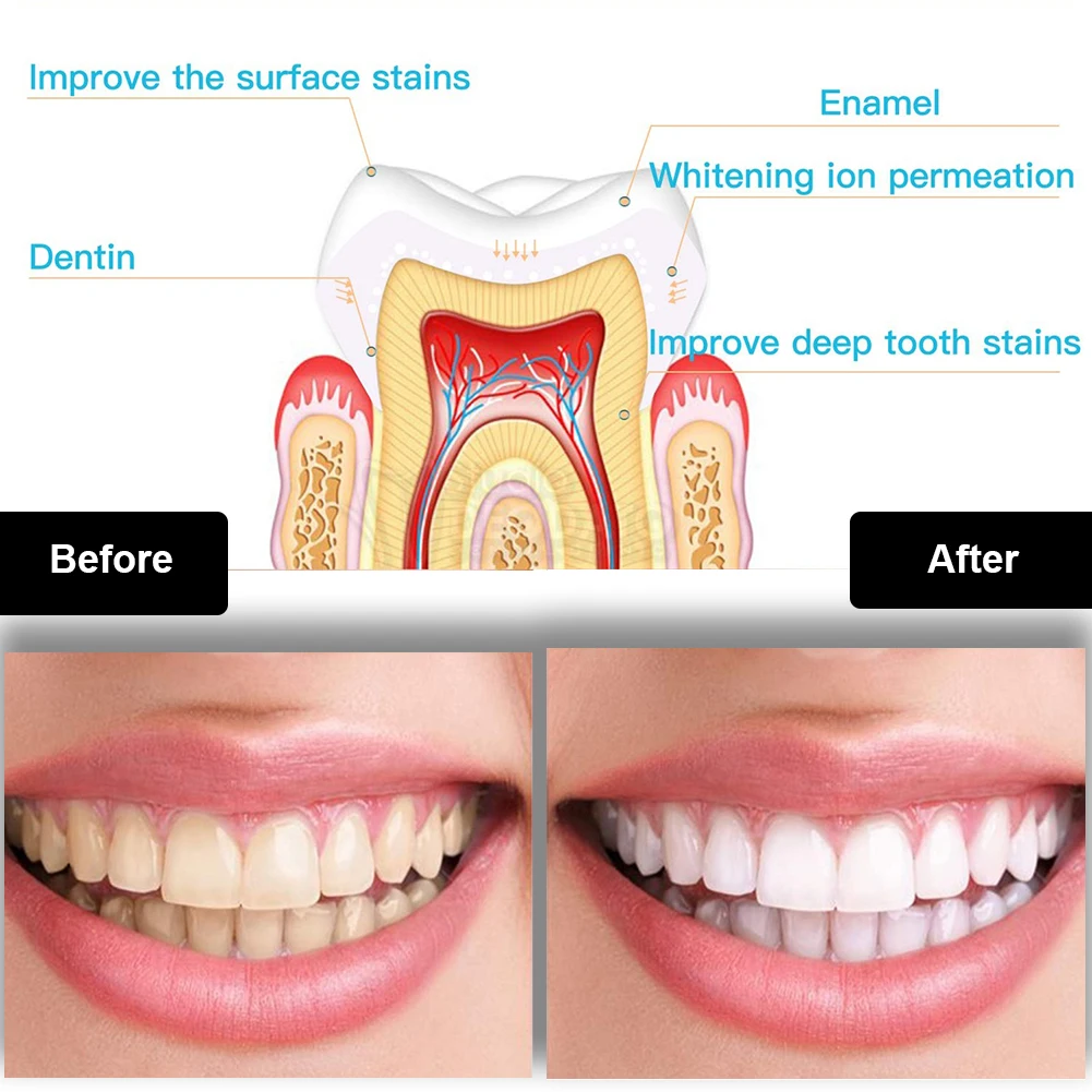 Dental Teeth Whitening Kit Min - Teeth Whitening Flash recension och pris