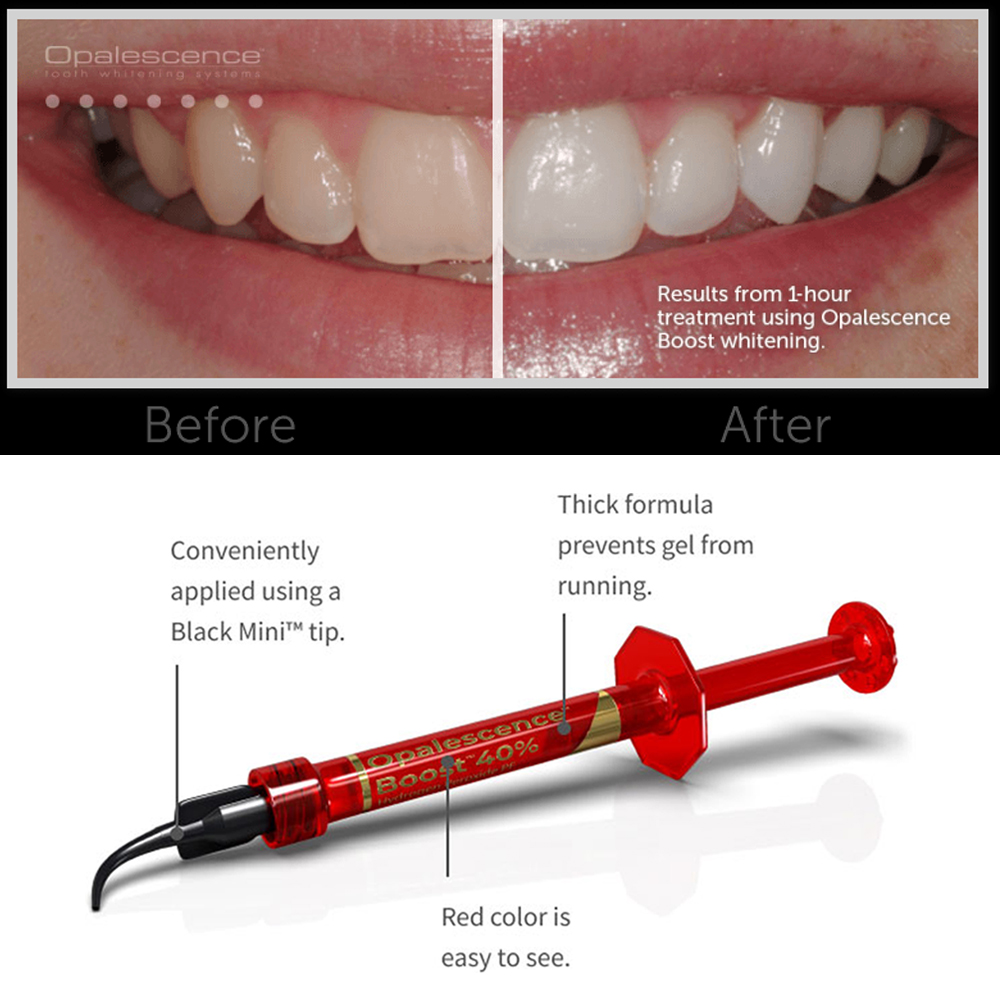 Ultradent Opalescence Boost PF - Teeth Whitening Gel Opalescence recension och pris